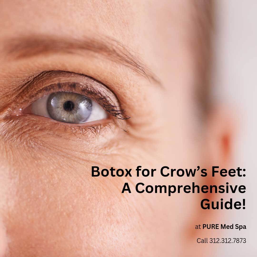 Botox For Crow’s Feet A Comprehensive Guide Pure Medical Spa