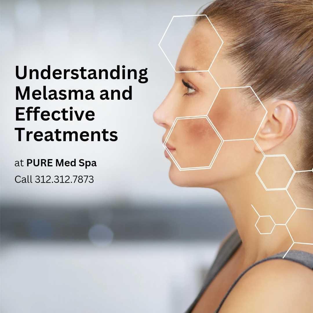 Understanding Melasma and Effective Treatments - PURE Medical Spa